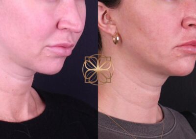 Profile view showcasing the enhanced jawline and neck profile after 3 months of AccuTite treatment