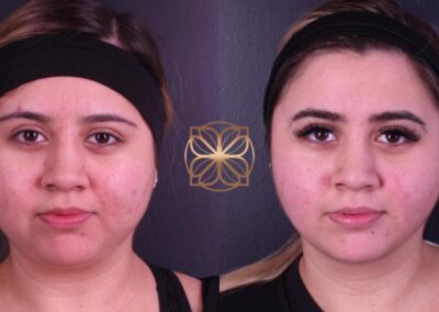 Dramatic skin enhancement following BFPR and FaceTite treatment at a Beverly Hills cosmetic clinic