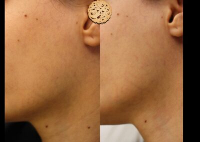 Dermaplaning