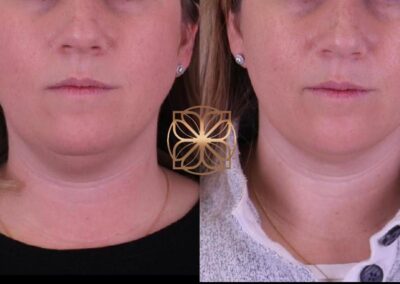 Frontal comparison view of Kybella treatment for neck fat reduction, showing a slimmer jawline and neck area