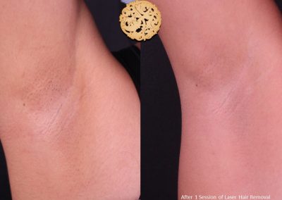Laser Hair Removal After 1 Session Spa26 Beverly Hills