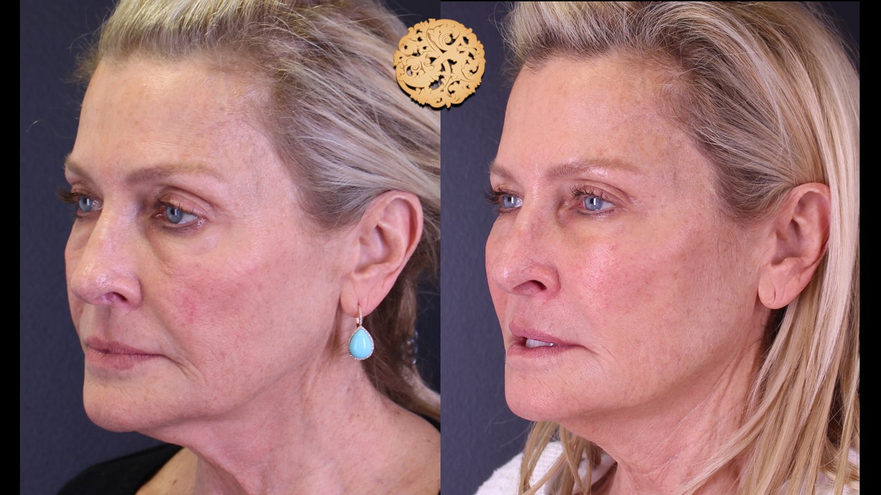 non surgical liquid facelift