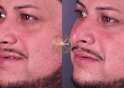 Side view of a man's facial enhancement with filler, illustrating improvements in nasal and cheek area