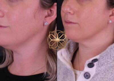 Before and after side profile of neck contouring with Kybella treatment, showing reduced under-chin fullness