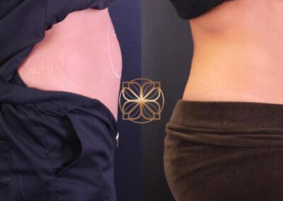Side view showing abdominal contouring post-Kybella injections, with notable reduction in belly fat