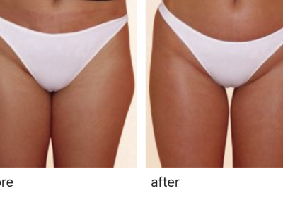 Zimmer Z Wave before and after 3