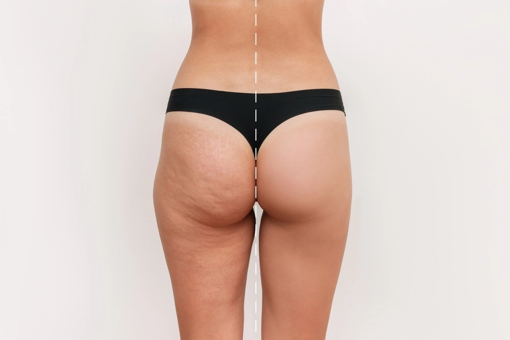 Before and after results of Cellfina cellulite treatment showing smoother and firmer skin on the thighs and buttocks.