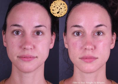 Frontal comparison of Restylane Lyft filler treatment on woman's face.