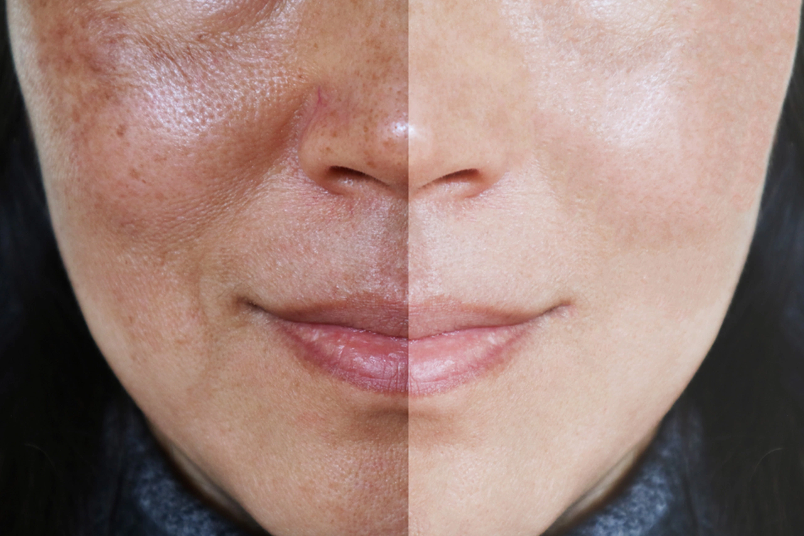 Power Peel For Melasma Spa26 Beverly Hills