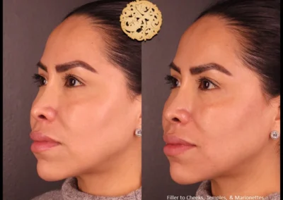 Three-quarter view before and after Restylane Lyft to cheeks and temples.